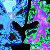 Una analítica de sangre permite conocer la progresión del alzhéimer