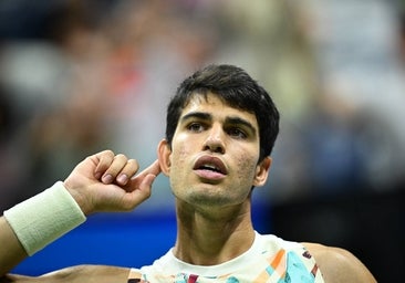 ¿Es posible eliminar el acné para siempre?