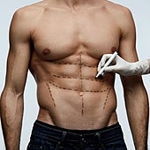 Lipoescultura de alta definición, la técnica para eliminar la grasa y definir los músculos