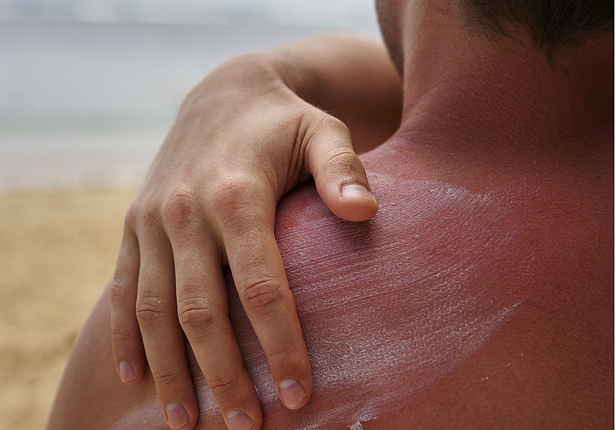 Cinco errores habituales al usar la crema solar que podrían provocar quemaduras en la piel