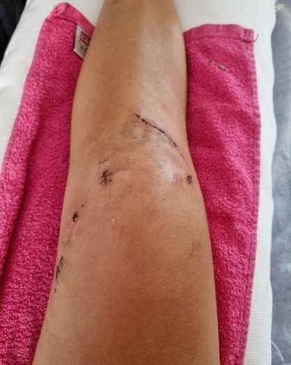 Carolina Marín muestras las heridas de su operación y dice que ha 'llorado mucho' y que ni los médicos saben cuando podrá volver