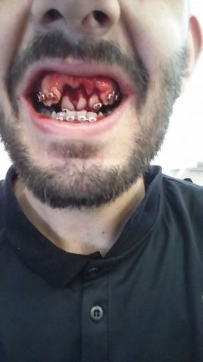 Destrozan los dientes al ex albiazul Bardanca en el Melilla-Jaén y no pitan ni falta