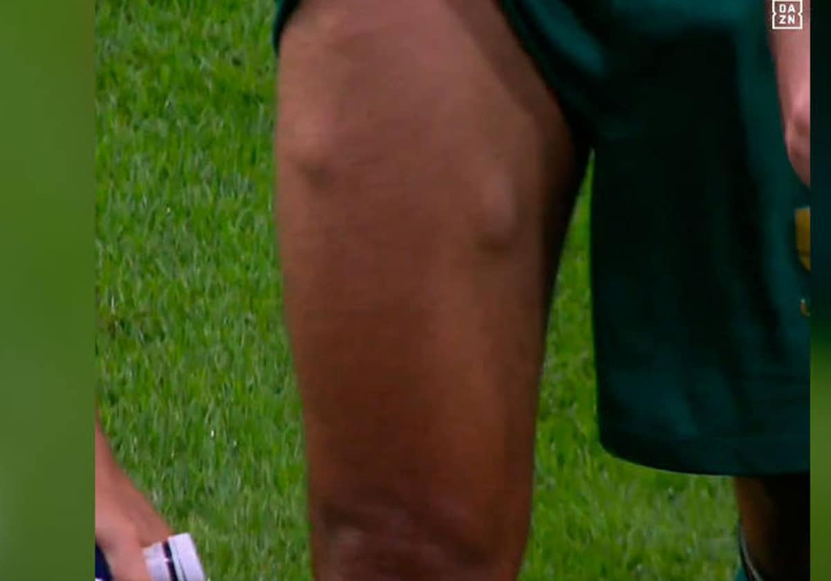 Los extraños bultos en la pierna de Fali tras salir con una lesión del Metropolitano