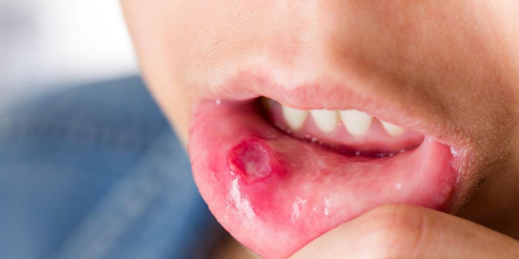 Qué es la enfermedad del bocamanopie en los niños, cuáles son los