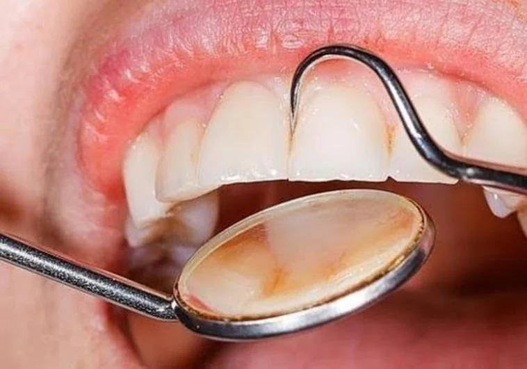 Síntomas que avisan de que puedes tener un cáncer de lengua