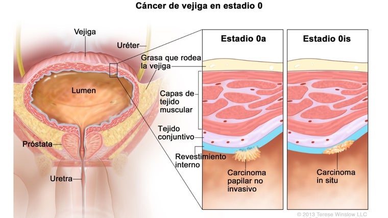 Cáncer de vejiga en estadio inicial