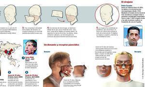 Primer trasplante de cara en España