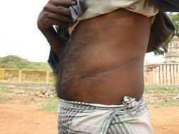 Viajes con trasplante incluido