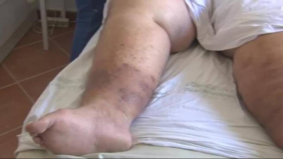 Teófilo aumenta de peso mientras espera en el Hospital de Manises una solución a su problema