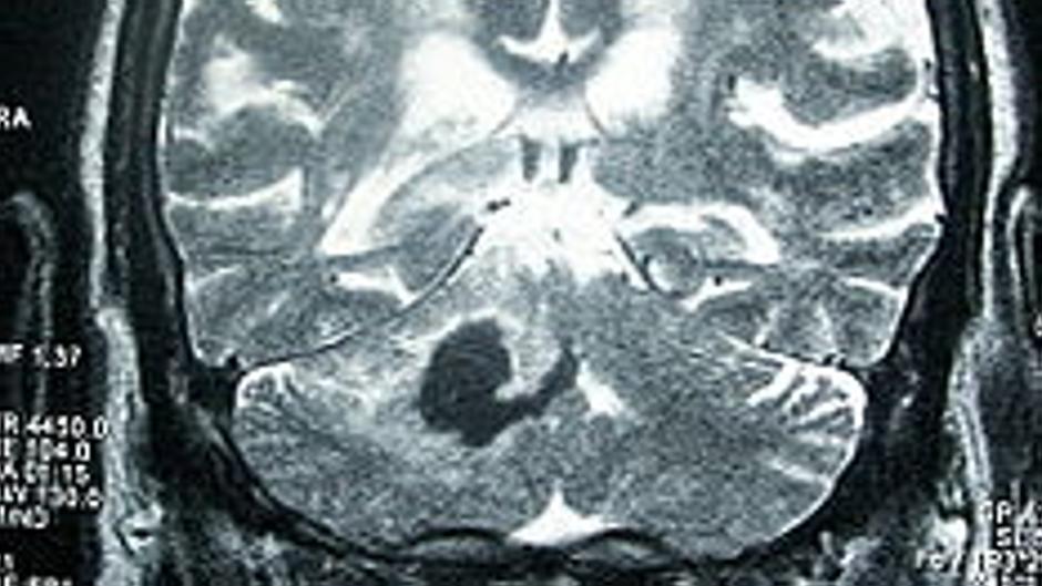 ¿Cuáles son las señales de alarma de un derrame cerebral?