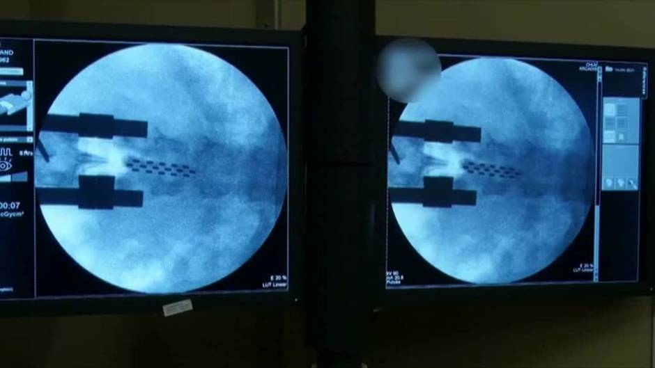 Tres parapléjicos vuelven a caminar un día después de haber recibido un implante electrónico en la médula