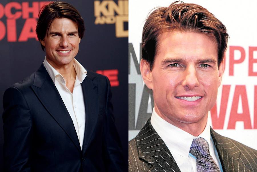 Tom Cruise ha recurrido al botox para disimular las patas de gallo y rellenar sus pómulos. 