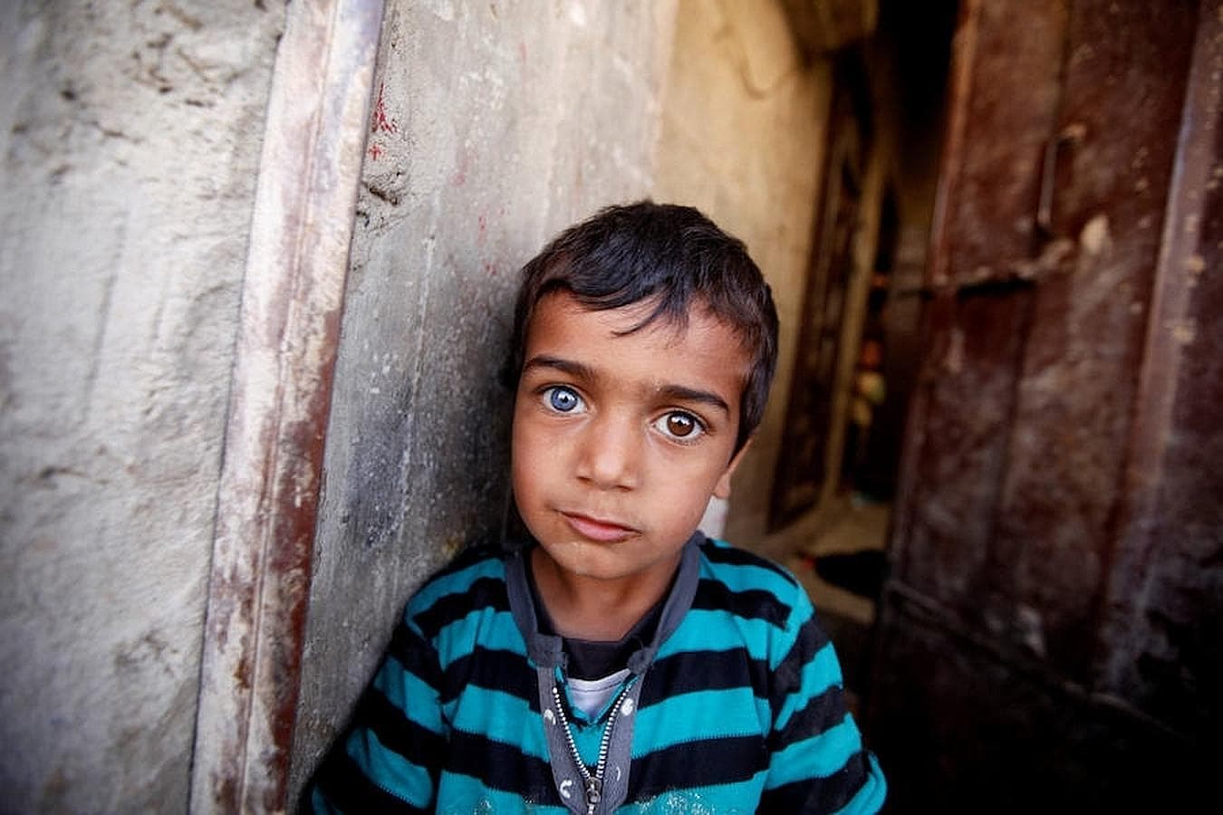 Un niño con los ojos de diferentes colores mira a cámara desde su casa en la ciudad de Saná