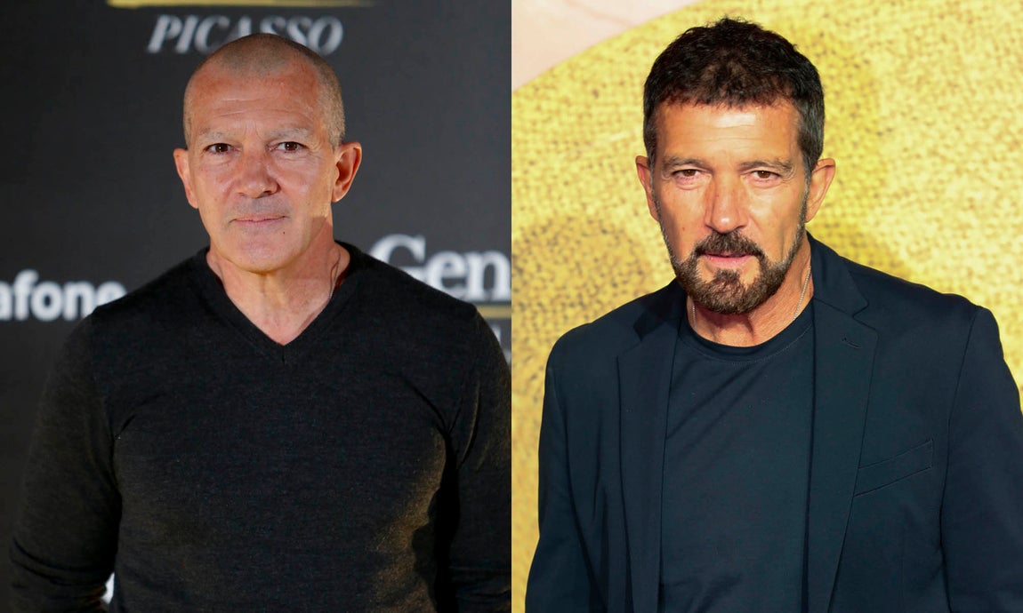 Antonio Banderas. Aunque no ha hablado sobre su trasplante, es evidente, viendo ambas imágenes, que el actor malagueño también ha recurrido a este tratamiento para lucir un cabello más denso. En 2018 posaba con el pelo rapado y unas evidentes entradas que, en la actualidad, han desaparecido.