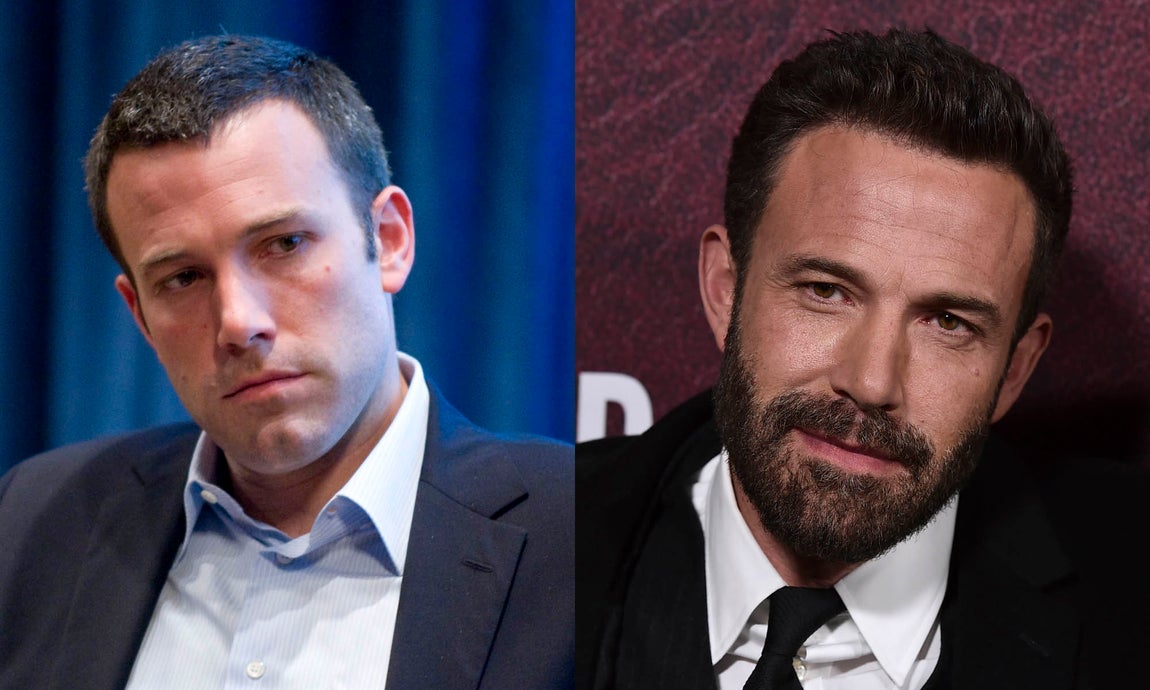 Ben Affleck. En 2008 el actor mostraba entradas evidentes que han desaparecido en la actualidad, gracias al injerto capilar, un tratamiento permanente que permite repoblar con pelo propio zonas que presentan alopecia o caída intensa.