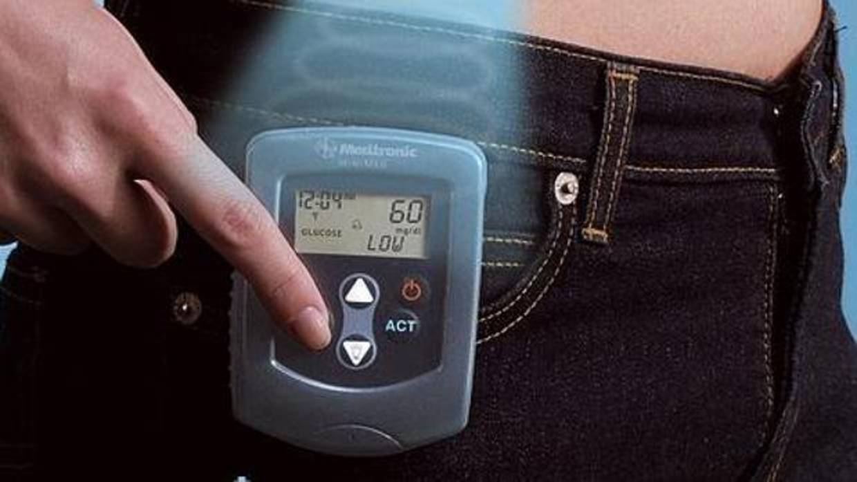 La bomba de insulina es un pequeño dispositivo del tamaño de un teléfono móvil