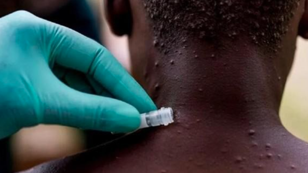 Andalucía mantiene los cinco casos confirmados de viruela del mono