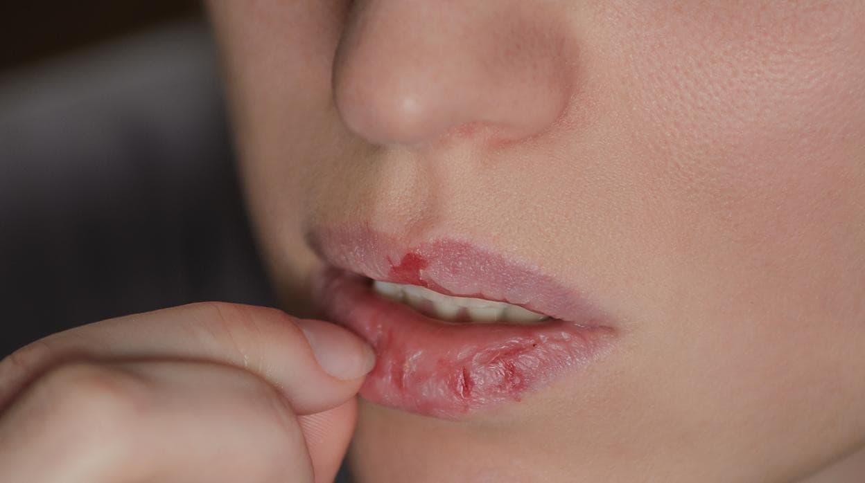 Dermatofagia: el motivo por el que te muerdes el labio, los dedos o la piel