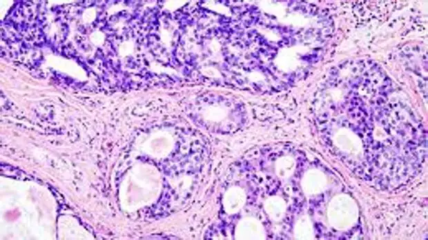 Células del cáncer de mama