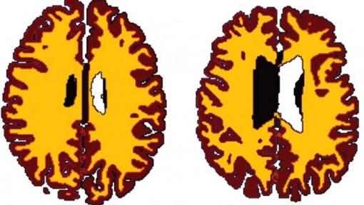 Comparación de la materia gris (color marrón) y la sustancia blanca (amarillo) en personas con y sin sobrepeso (izquierda)