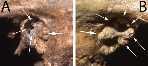 Dos vistas del canal auditivo del fósil de Shanidar 1 muestran deformidades que probablemente le habrían causado sordera profunda