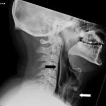 Radiografía del cuello del afectado. La flecha marca la presencia de lesiones provocadas por el estornudo