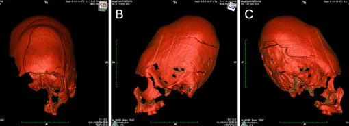 Tomografía computarizada del cráneo alargado