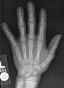 Radiografía de una mano de un niño de 8 años.
