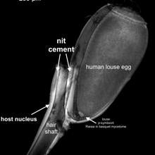 'Nit cement' es el 'cemento' que mantiene pegada la liendre al cabello y de donde se ha podido recuperar el ADN humano