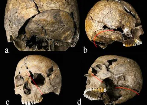 Un esqueleto revela los daños de la escalofriante práctica medieval de la «rueda de la tortura»