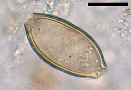 Huevo microscópico de tricocéfalo identificado en el orinal