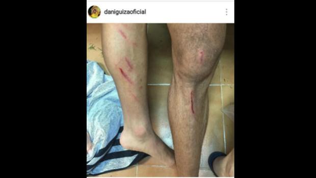 Güiza y Álvaro enseñan sus heridas de guerra