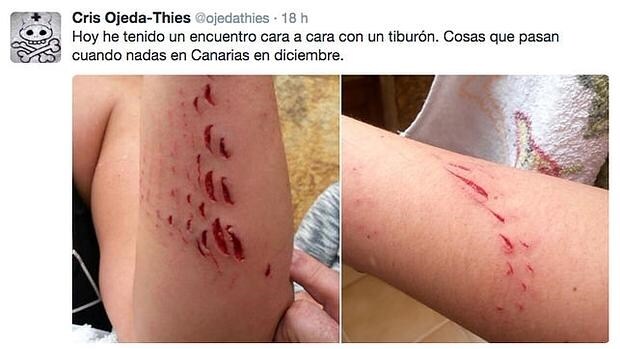 Una turista atacada por un tiburón mientras nadaba en Canarias