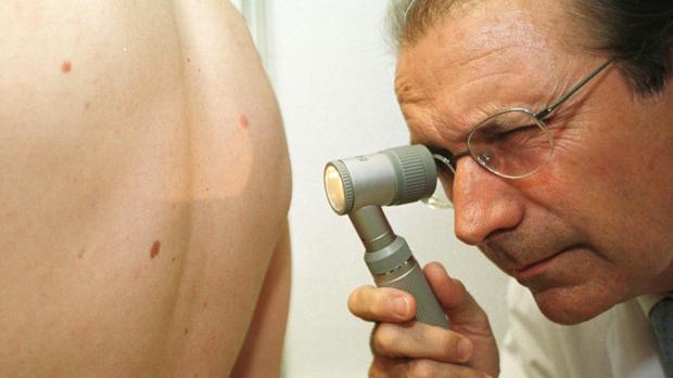 Imagen de archivo de un un lunar melanoma