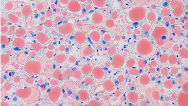 La tinción de secciones de hígado de ratones que muestran la esteatosis hepática (hígado graso), con acumulación de grasa, las gotas de lípidos (en rojo), dentro de las células. Cell núcleos mancha azul (C Maíllo, el IRB Barcelona)