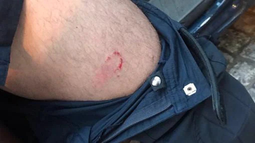 Heridas de uno de los agentes lesionados en la reyerta