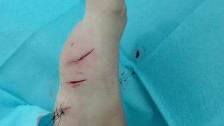 Pierna del menor sufero herido por mordedura de tiburón en Canarias