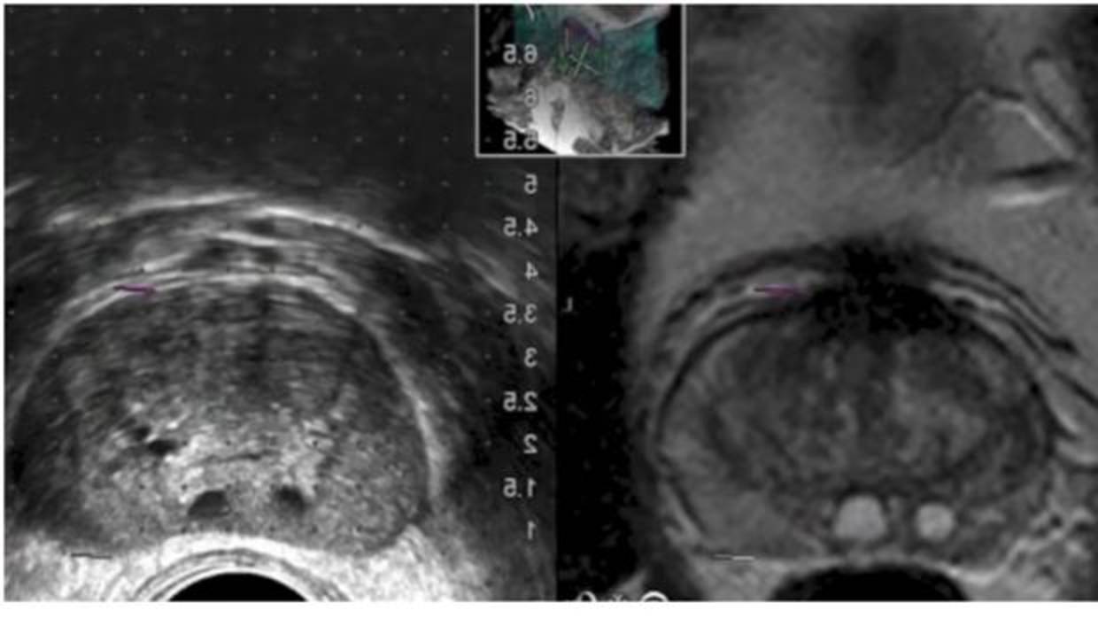 Canarias acelera en la precisión detectar en cáncer de próstata