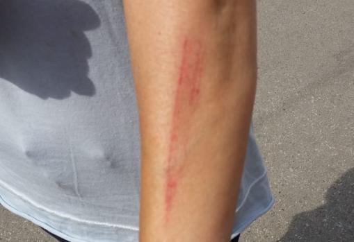 Imagen del brazo de na de las mujeres agredidas mientras retirava las cruces de la playa