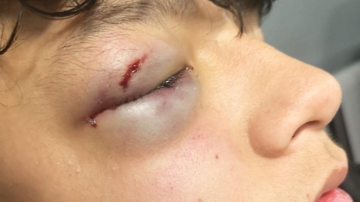 Imagen del ojo del menor, de 15 años, tras el ataque