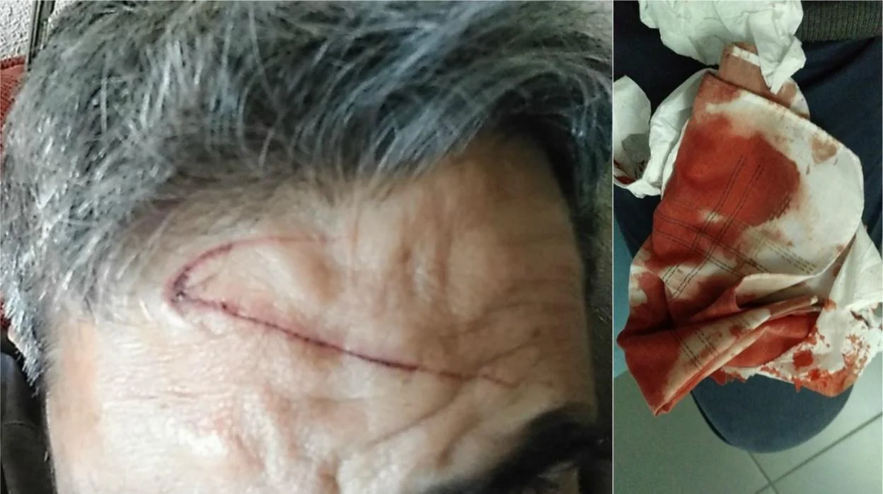 El hombre golpeado, junto a un pañuelo ensangrentado tras la agresión