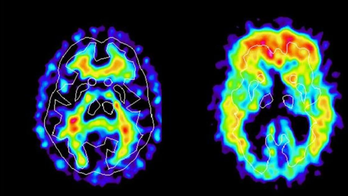 Descubren dos nuevos genes implicados en la enfermedad de Alzheimer
