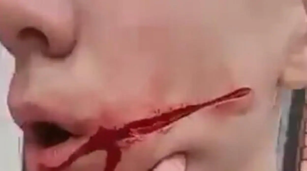 El menor ha colgado en redes sociales un vídeo que grabó nada más sufrir la agresión
