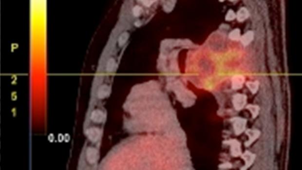 Extirpan un tumor enorme que desplazaba los pulmones y el esófago a un hombre tras 24 horas de operación