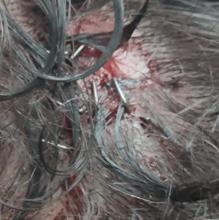 Varias de las grapas que le pusieron a Mikel en la cabeza