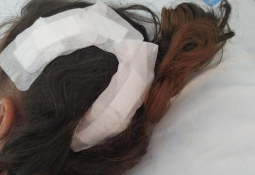 Gasas y apósitos en la cabeza de la víctima tras la operación