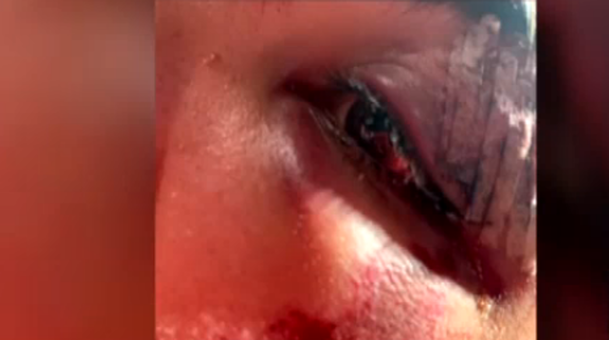 Imagen del ojo del joven tras la brutal agresión por parte de tres residentes del centro de menas de Hortaleza