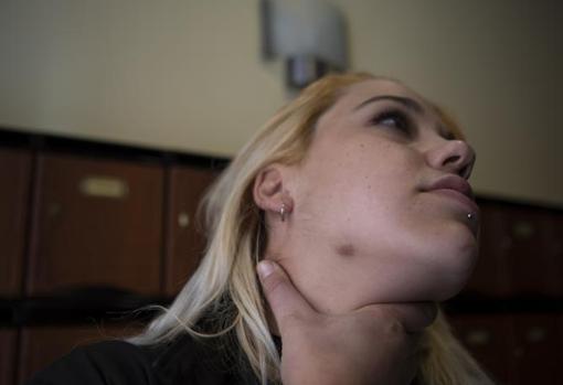 Laura muestra la marca del mataleón, en su mandíbula derecha