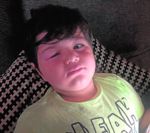 Un niño con el ojo hinchado por una mordedura de la mosca negra que llevaron a urgencias