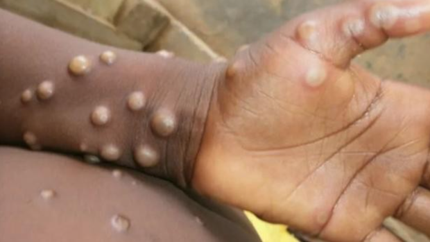Canarias registra el primer caso sospechoso de viruela del mono